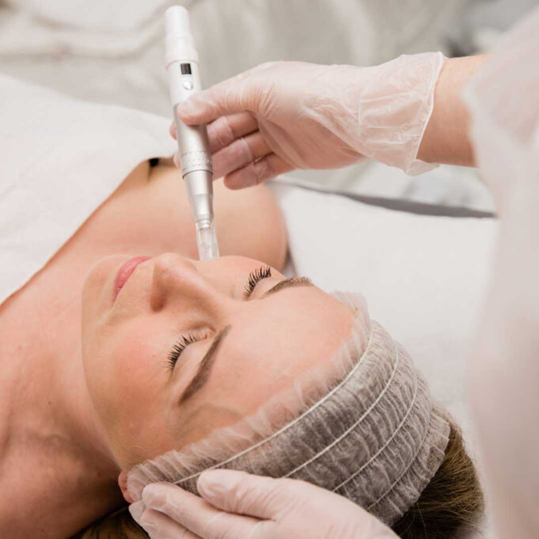 Microneedling-01